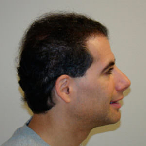 6 Month Results After Double Hair Transplant Correctional Procedure Before And Afters 