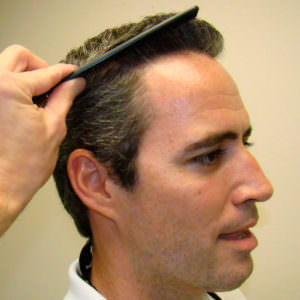 Hairline And Crown Thickening Hair Transplant Before And Afters Crown Hairline 
