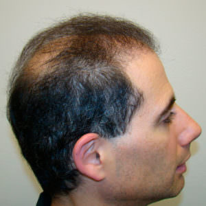 6 Month Results After Double Hair Transplant Correctional Procedure Before And Afters 