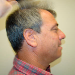 Dr. Bolton - Great Hair Transplants Updates Large Balding Area? 1 MaxHarvest™ Hair Transplant Before And After Comparison Before And Afters Crown Difficult Cases Hairline
