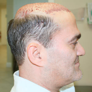 This Is The Most Effective Way To Restore Your Hair Before And Afters Crown Difficult Cases Hair Transplant Industry Exposed Hairline Healing/Growth Process MaxHarvest Plus™ Procedures 