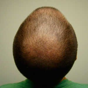 Ryan's Full Hair Transplant Journal Healing/Growth Process Testimonials 
