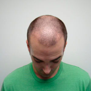 Ryan's Full Hair Transplant Journal Healing/Growth Process Testimonials 