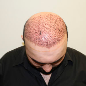 The Largest Hair Transplant Case In History Before And Afters Crown Difficult Cases Hair Transplant Industry Exposed Hairline Healing/Growth Process MaxHarvest Plus™ Procedures 
