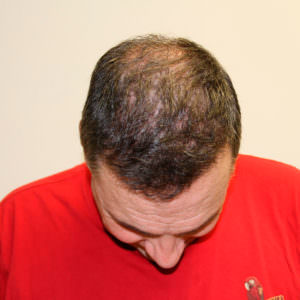 Two Hair Transplants Are Better Than 1 Before And Afters Hairline Healing/Growth Process