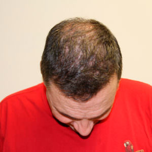 Two Hair Transplants Are Better Than 1 Before And Afters Hairline Healing/Growth Process 