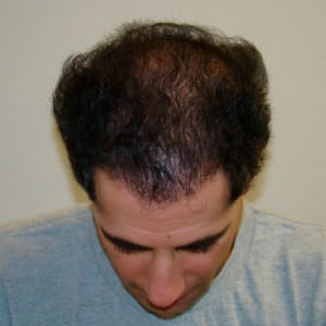 6 Month Results After Double Hair Transplant Correctional Procedure Before And Afters