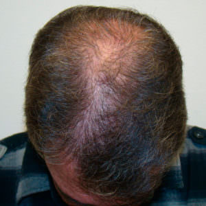 Large Balding Area? 1 MaxHarvest™ Hair Transplant Before And After Comparison Before And Afters Crown Difficult Cases Hairline 