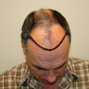 Two Hair Transplants Are Better Than 1 Before And Afters Hairline Healing/Growth Process 