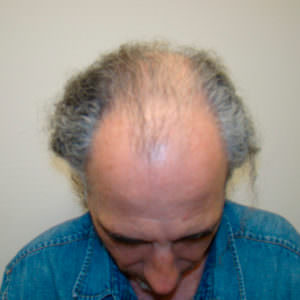 Full Coverage On A Large Area After Hair Transplant Before And Afters Crown Difficult Cases Hairline
