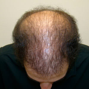 6 Month Results After Double Hair Transplant Correctional Procedure Before And Afters 