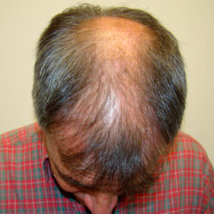 Large Balding Area? 1 MaxHarvest™ Hair Transplant Before And After Comparison Before And Afters Crown Difficult Cases Hairline 