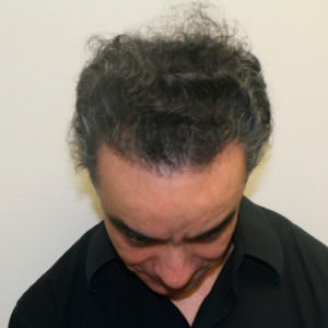 Great Hair Transplant Results Can Take Longer Than 12 Months Before And Afters Crown Healing/Growth Process Testimonials 