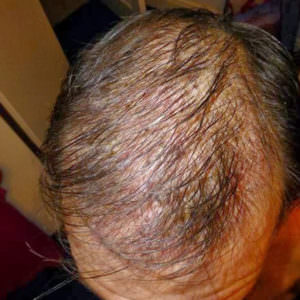 European Patient Flies In To Have Hair Transplant Before And Afters Crown Hairline Healing/Growth Process MaxHarvest Plus™ Procedures