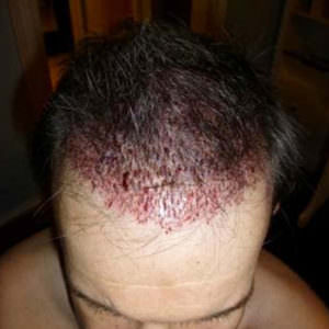 European Patient Flies In To Have Hair Transplant Before And Afters Crown Hairline Healing/Growth Process MaxHarvest Plus™ Procedures 