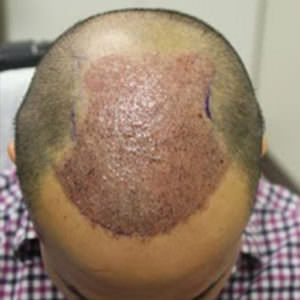 Which Type Of Hair Transplant Procedure Will You Opt For? Difficult Cases FUE Corrections Hair Transplant Industry Exposed 