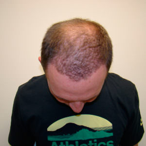 Life-Changing Hair Transplant Results Before And Afters Difficult Cases Hairline Healing/Growth Process