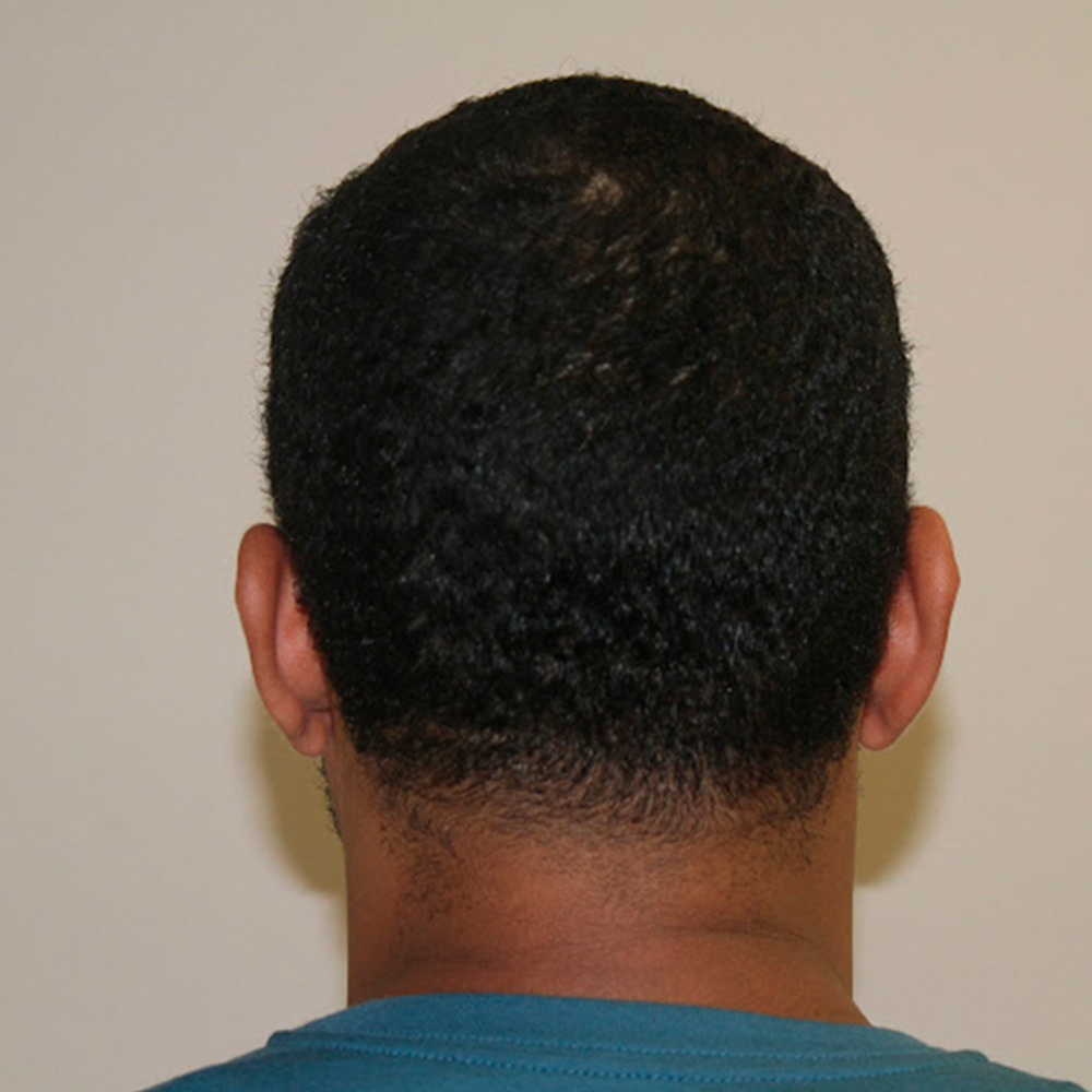 5 Month Complete Hairline Restoration Results Before And Afters Hairline Healing/Growth Process Suture Line/Scar