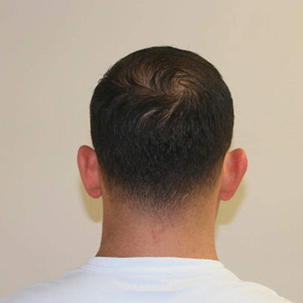 Worried About A Scar After A Hair Transplant? Before And Afters Hairline Suture Line/Scar