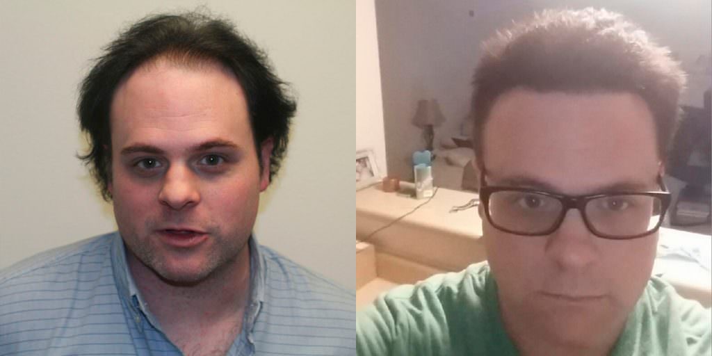 Tony's Continued Progress - Update 5 1/2 Months After Second Procedure! Before And Afters Hairline Healing/Growth Process 