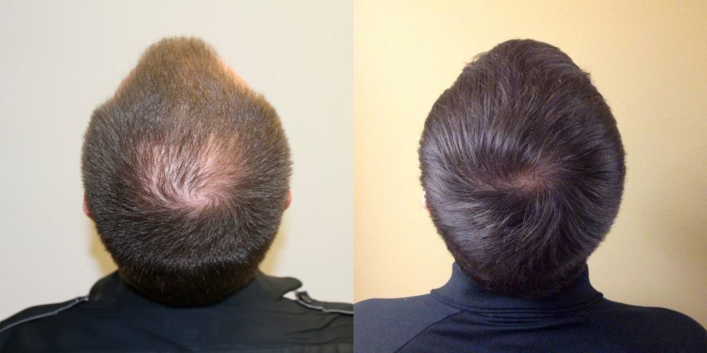 Premature Hair Loss Correction Before And Afters Crown Hairline Healing/Growth Process 