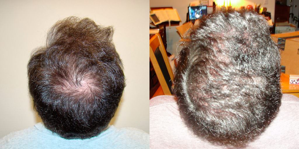 From Thin To Thick Hair In 1 Hair Transplant Before And Afters Crown Hairline 