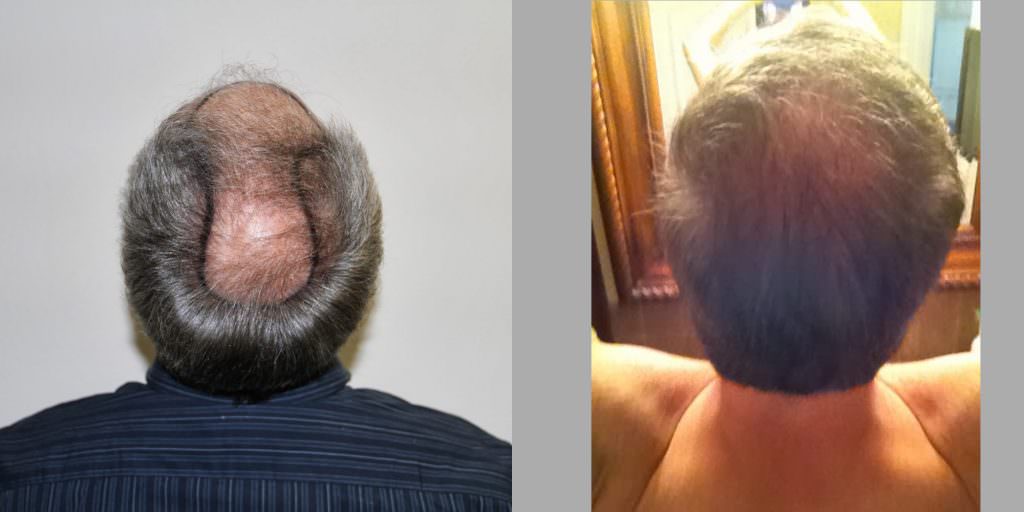 Thicken Your Hair With A Proven Hair Growth Method Before And Afters Crown Difficult Cases Hairline MaxHarvest Plus™ Procedures