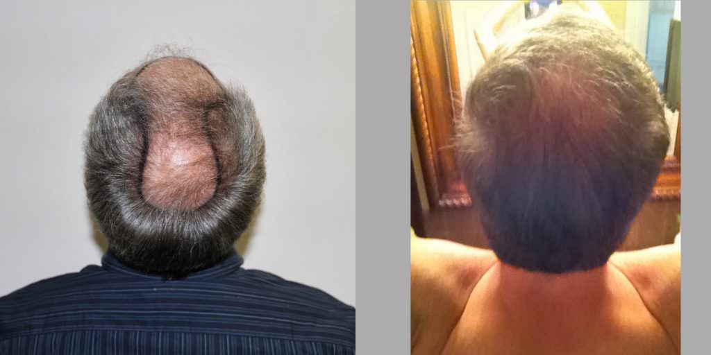 Thicken Your Hair With A Proven Hair Growth Method Before And Afters Crown Difficult Cases Hairline MaxHarvest Plus™ Procedures 