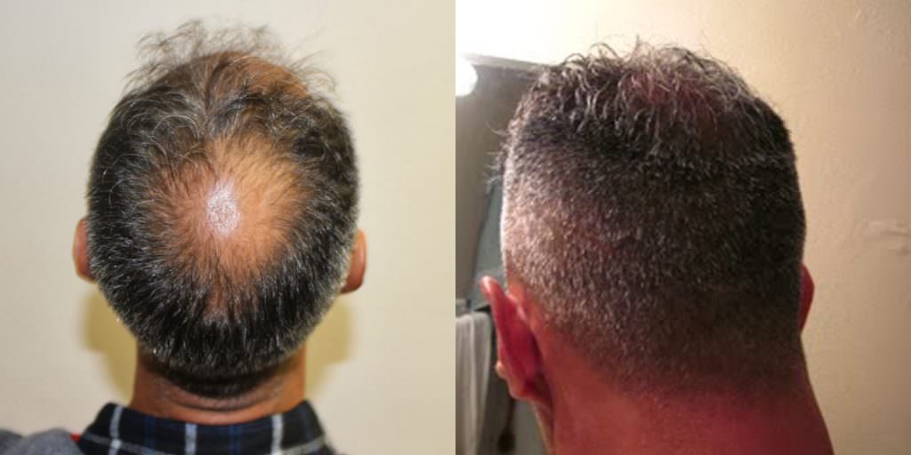 Incredible Results With No Trace Of A Hair Transplant Before And Afters Crown Difficult Cases Hairline 