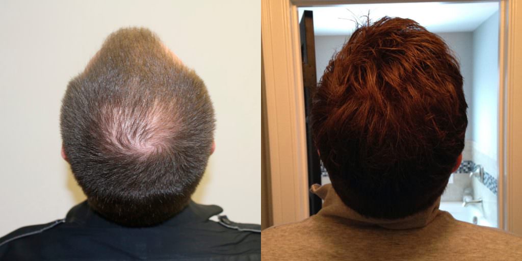 Premature Hair Loss Correction Before And Afters Crown Hairline Healing/Growth Process 