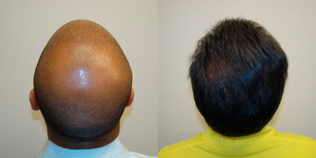 Aldo's Ridiculous 5 Month Transformation - World Famous Hair Transplant Results Before And Afters Crown Difficult Cases Hairline Healing/Growth Process 