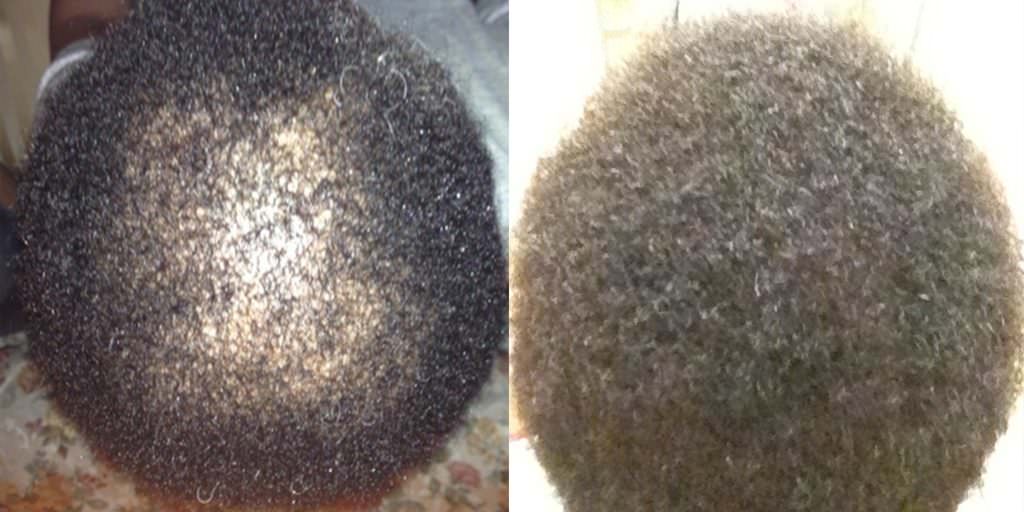 Young African American Female's Hair Transplant Results African American Patients Before And Afters Crown Women 