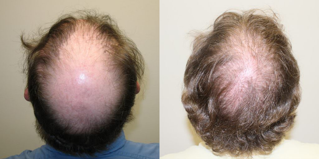 Dr. Bolton Greatly Improves Botched Hair Transplant Before And Afters Crown Difficult Cases Hair Transplant Industry Exposed 