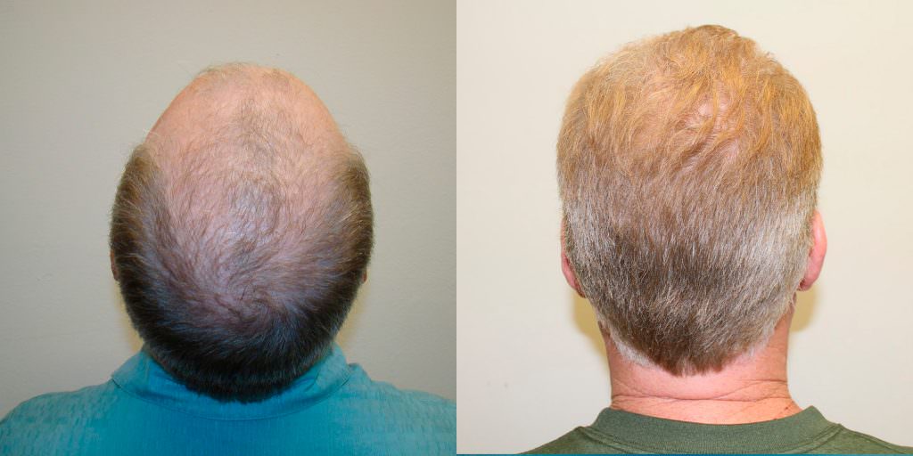 Complete Hair Loss Transformation After Just 1 MaxHarvest Plus™ Procedure Before And Afters Crown Difficult Cases Hairline Healing/Growth Process MaxHarvest Plus™ Procedures 