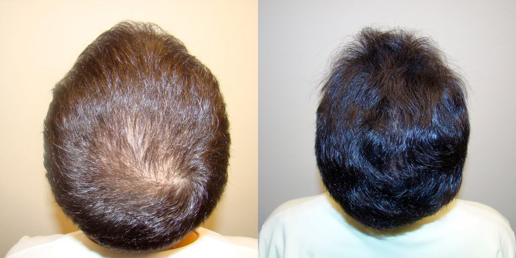 Young Man's Hairline and Crown Restoration Before And Afters Crown Hairline 