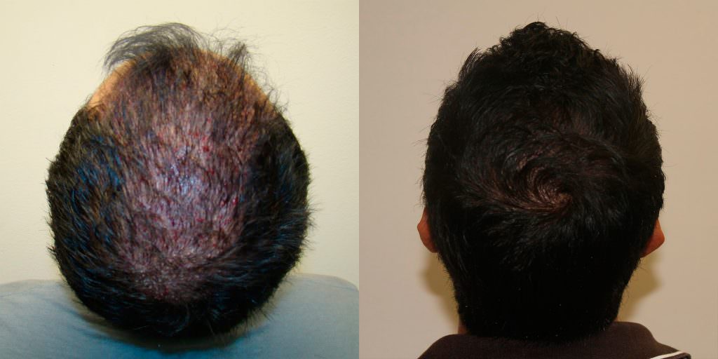 Full And Thick Density, 1 Procedure Hair Transplant Result Before And Afters Crown Healing/Growth Process