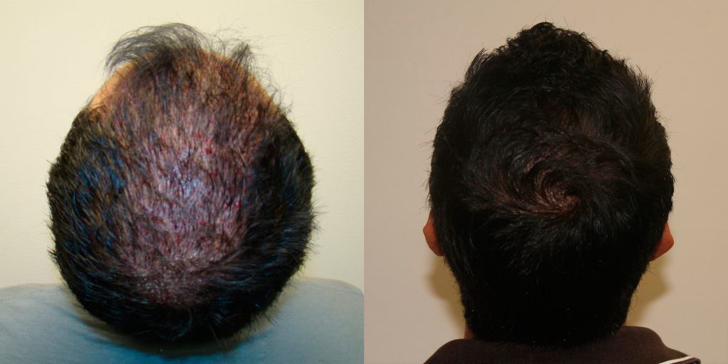 Full And Thick Density, 1 Procedure Hair Transplant Result Before And Afters Crown Healing/Growth Process 