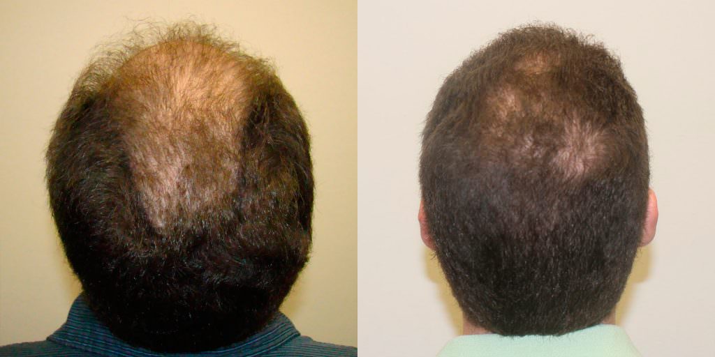 Twenty Year Old's Hair Transformation To Fix Hairline Before And Afters Difficult Cases Hairline 