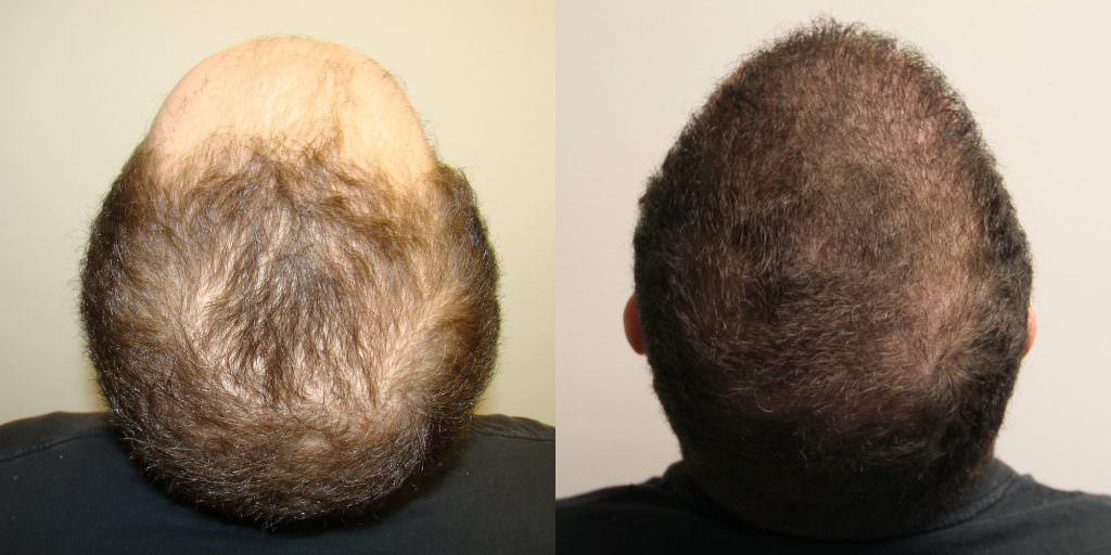 19 Year Old's Completely Restored Look After Hair Transplant Before And Afters Crown Difficult Cases Hairline Testimonials 