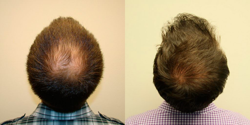 Ryan's Full Hair Transplant Journal Healing/Growth Process Testimonials 