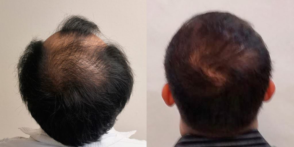 Napalese Patient's MaxHarvest Plus™ Hair Transplant Results At Halfway Point Before And Afters Crown Difficult Cases Hairline Healing/Growth Process MaxHarvest Plus™ Procedures 