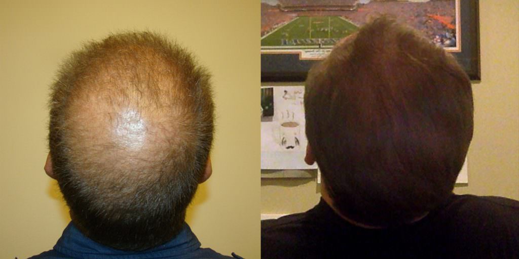 Density Improvement Across Entire Head With MaxHarvest Plus™ Hair Transplant Before And Afters Crown Difficult Cases MaxHarvest Plus™ Procedures 