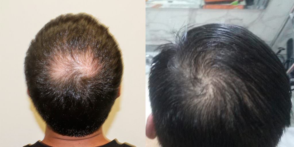 Hair Loss On The Back Of Your Head? Before And Afters Crown 