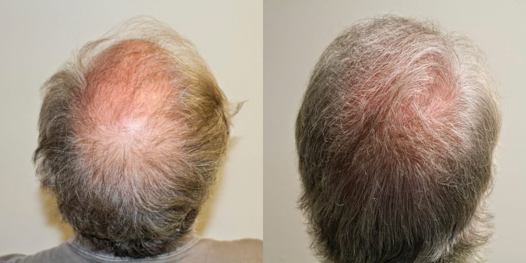 Hair Transplant Before And After Importance Before And Afters Crown Difficult Cases Healing/Growth Process 