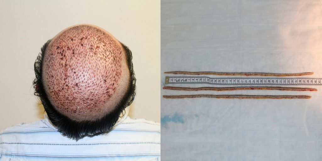 Napalese Patient's MaxHarvest Plus™ Hair Transplant Results At Halfway Point Before And Afters Crown Difficult Cases Hairline Healing/Growth Process MaxHarvest Plus™ Procedures 