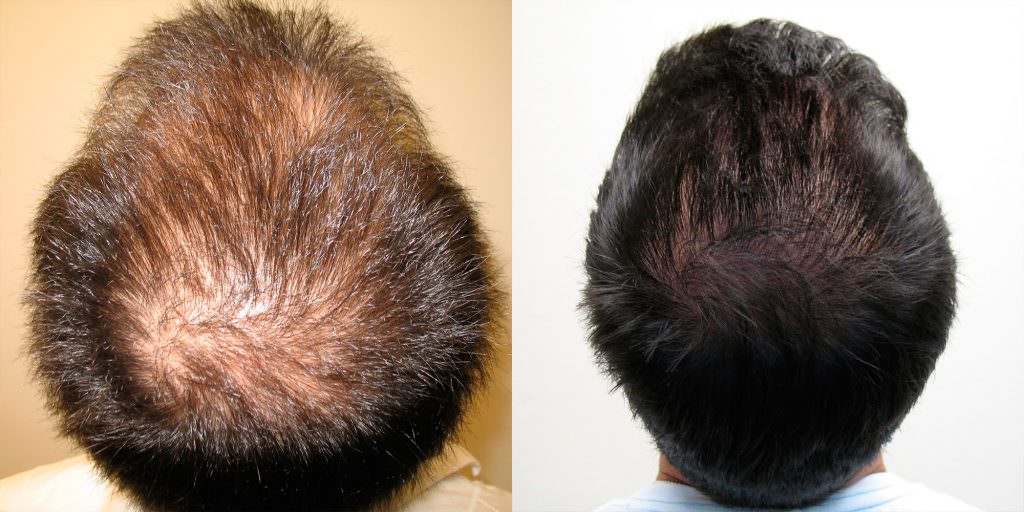 5 Years After Hair Transplant Follow-Up Before And Afters Hairline Healing/Growth Process 