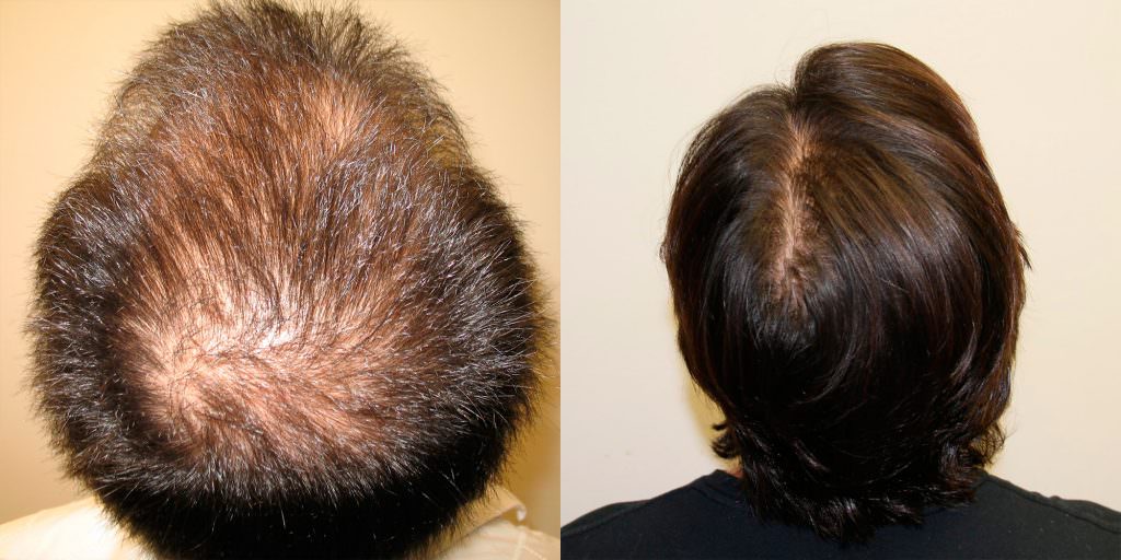 5 Years After Hair Transplant Follow-Up Before And Afters Hairline Healing/Growth Process 