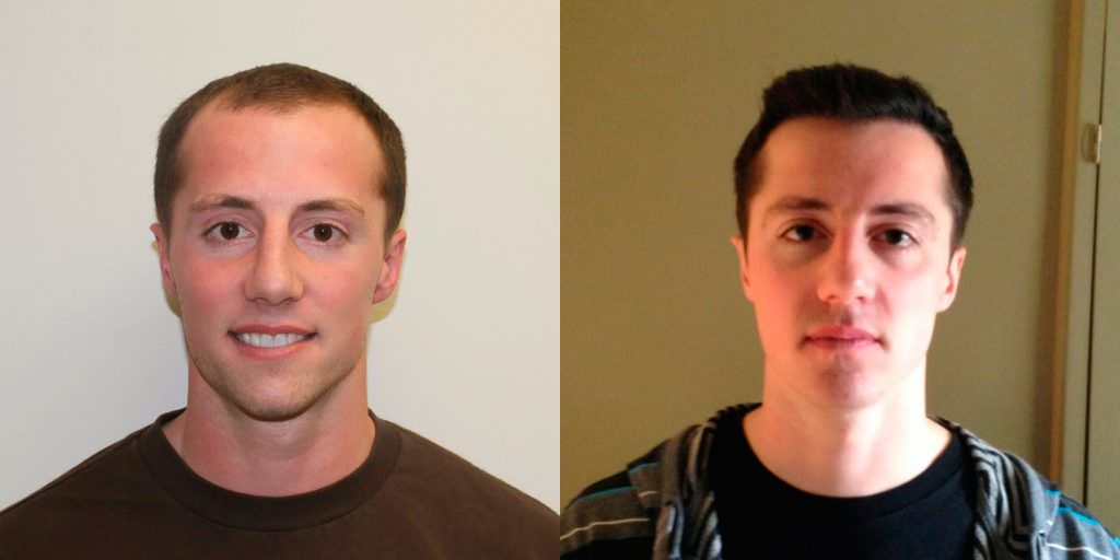 Young Man Flies In From California To Have A MaxHarvest™ Hair Transplant Before And Afters Hairline 