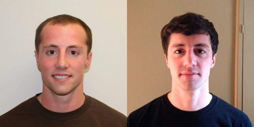 Young Man Flies In From California To Have A MaxHarvest™ Hair Transplant Before And Afters Hairline 