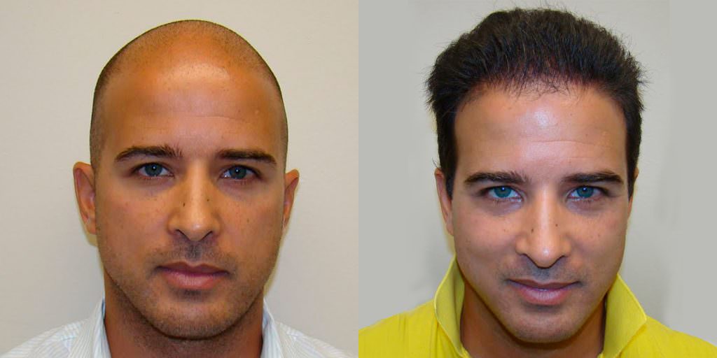 Aldo's Ridiculous 5 Month Transformation - World Famous Hair Transplant Results Before And Afters Crown Difficult Cases Hairline Healing/Growth Process 